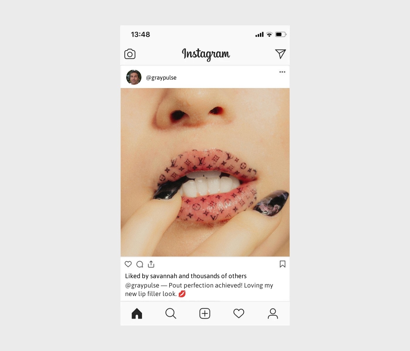 lip-filler-captions-for-instagram